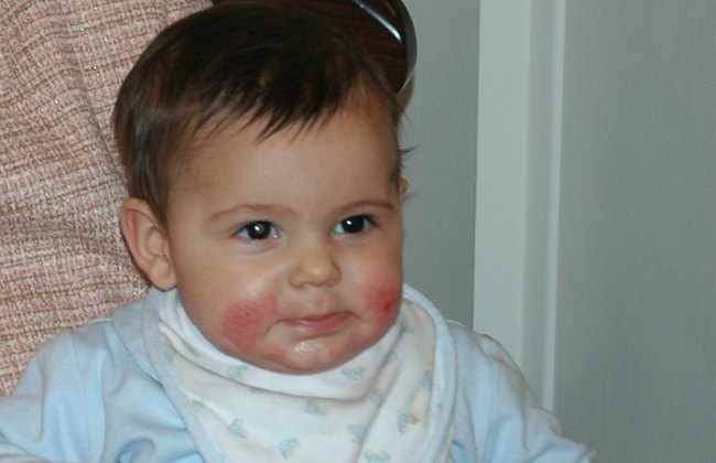 alergias alimentarias en bebes