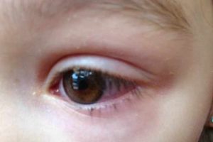Que es la conjuntivitis neonatal