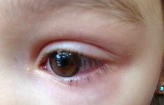 Que es la conjuntivitis neonatal