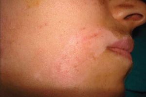 Vitiligo en adolescentes