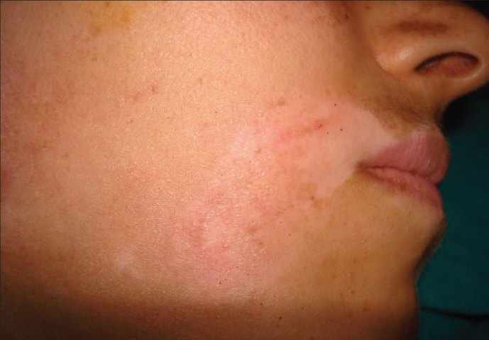 Vitiligo en adolescentes