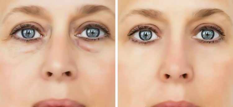 eliminar bolsas ojos sin cirugia eliminar bolsas ojos sin cirugia
